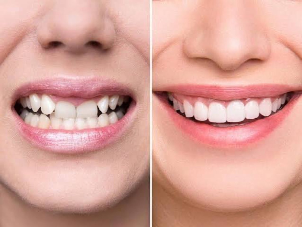 Caz real estetică dentară EbiDent — înainte și după
