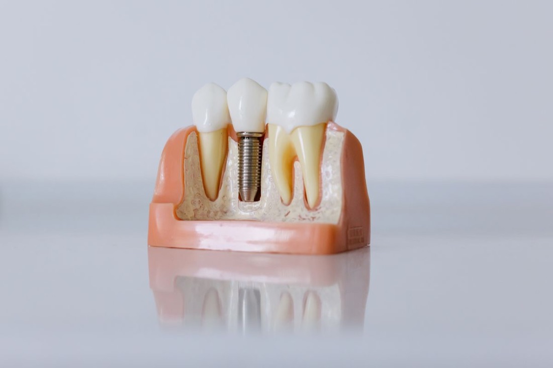Igiena după un implant dentar